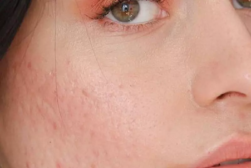 اسکار آتروفیک