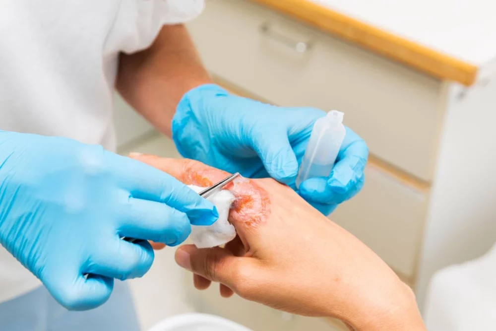 راهنمای گام به گام کندن پانسمان چسبیده به زخم