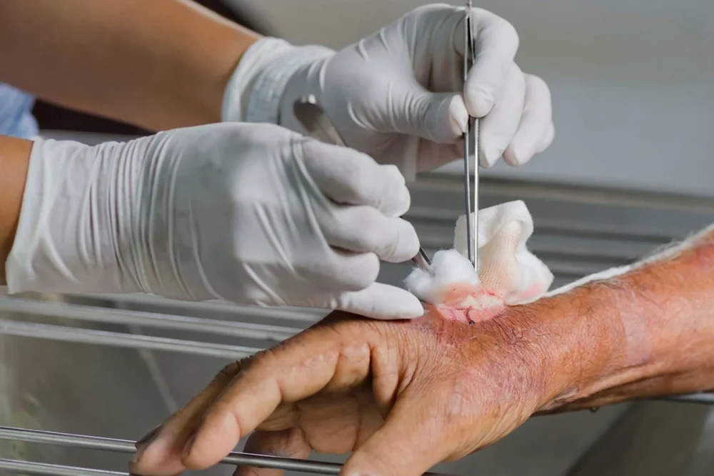 دبریدمان زخم