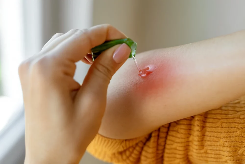 درمان خانگی سوختگی چیست؟