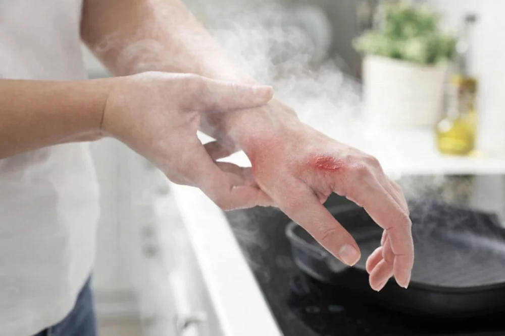 درمان سوختگی با بخار آب