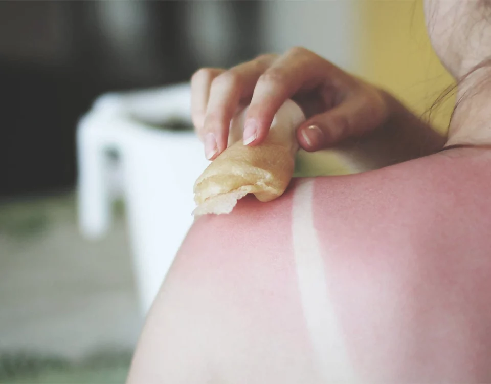 درمان خانگی آفتاب سوختگی صورت